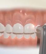 Illustration of laser being used on gums